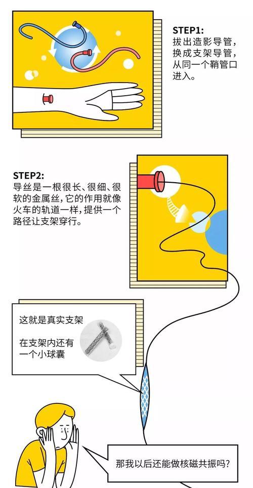 挎绳支架手机安装步骤是什么？安装中常见问题有哪些？